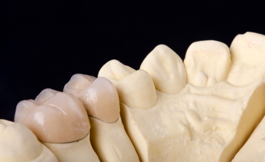 detail dental wax model